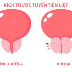 PSA Total, PSA Free - Chẩn đoán sớm ung thư Tuyến tiền liệt