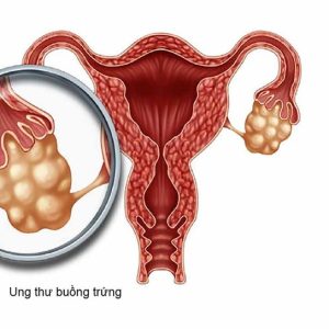 CA12-5-Chẩn đoán sớm ung thư Buồng trứng