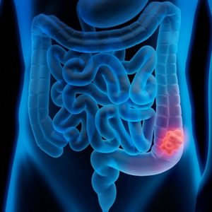 CEA - Chẩn đoán sớm ung thư Đại tràng, Đường tiêu hóa