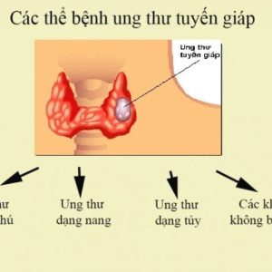 Calcitonin-Chẩn đoán sớm ung thư Tuyến giáp thể tủy