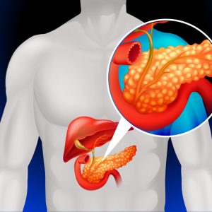 CA19-9 - Chẩn đoán sớm ung thư Tụy